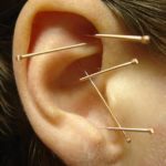 needles in ear