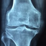 x ray of a healthy knee joint, from the back