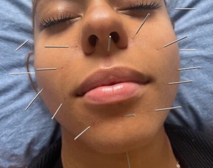 cosmetic acupuncture