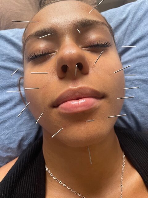 cosmetic acupuncture